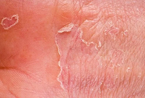 Eksim (Dermatitis)